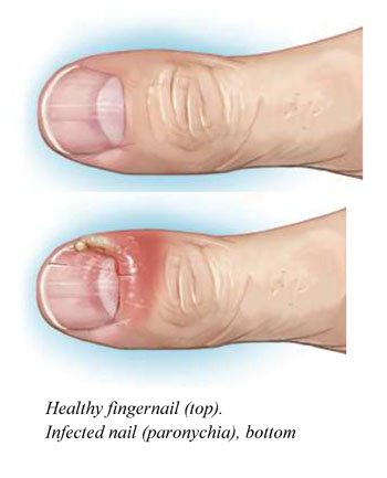 Nail Conditions Treatment at SkinVive in Hyderabad by Dr. Karishni Chittarvu