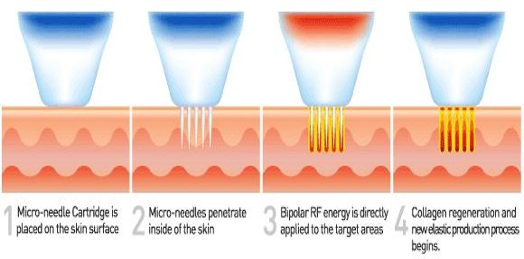 MNRF Anti Aging Treatment in Hyderabad at SkinVive by Dr. Karishni Chittarvu