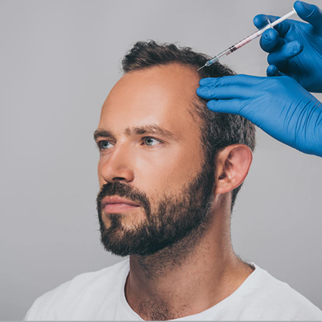 Mesotherapy and PRP for hair at SkinVive in Hyderabad by Dr. Karishni Chittarvu